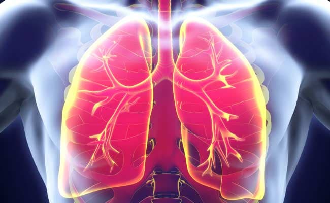 Pulmonary fibrosis can develop after lung injuries like infection, chemotherapy or radiation