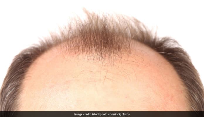 Smoking has been linked to increased hair loss due to the harmful effects it has on blood circulation