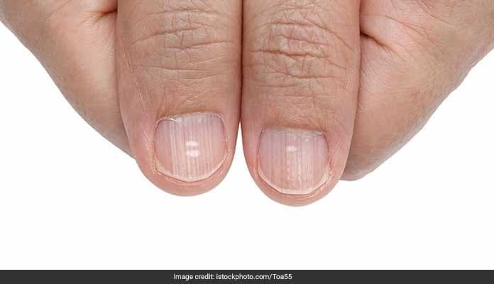 Nail biting can be stopped with these steps