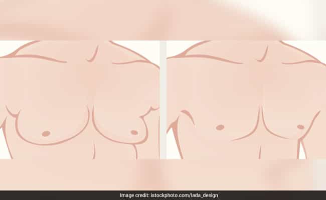 Gynecomastia may occur because of hormonal imbalance in testosterone and oestrogen in men