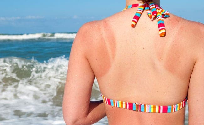 Prolonged sun exposure can cause tanning