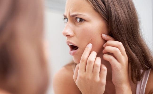 Skin Care: Simple kitchen ingredients can help you say goodbye to acne and pimples