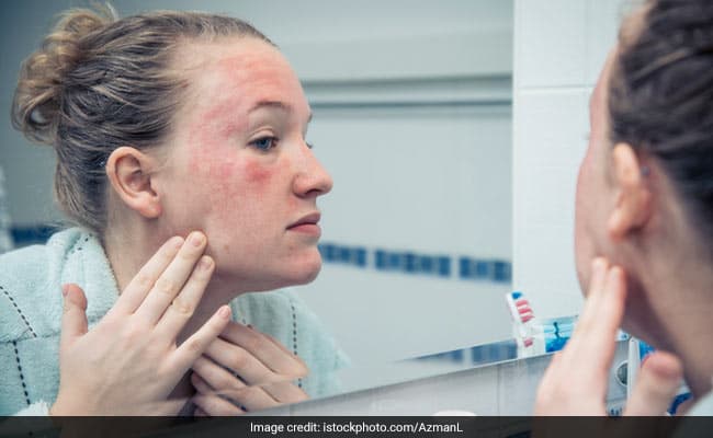 Eczema flare ups are likely to get worse during winter