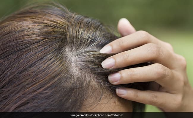 Henna can be an effective remedy for premature greying of hair