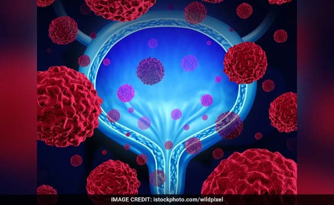 Infertility in men can cause prostate cancer; this stems from an unhealthy lifestyle
