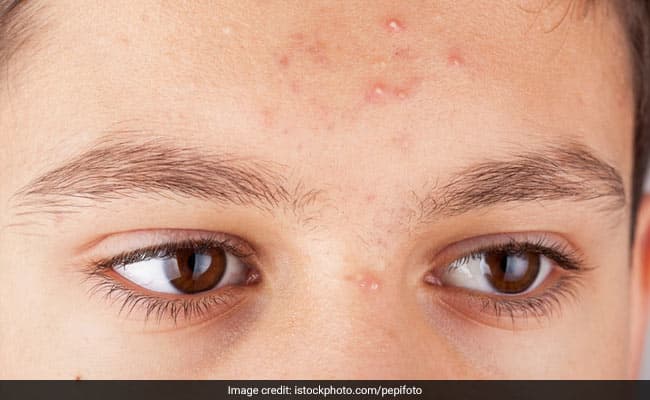 Quick fixes shouldn't be a substitute for long-term treatments for acne