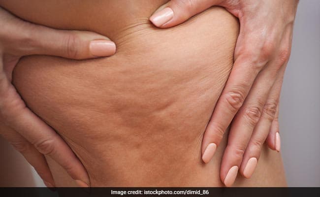 Excess weight can exacerbate the appearance of cellulite