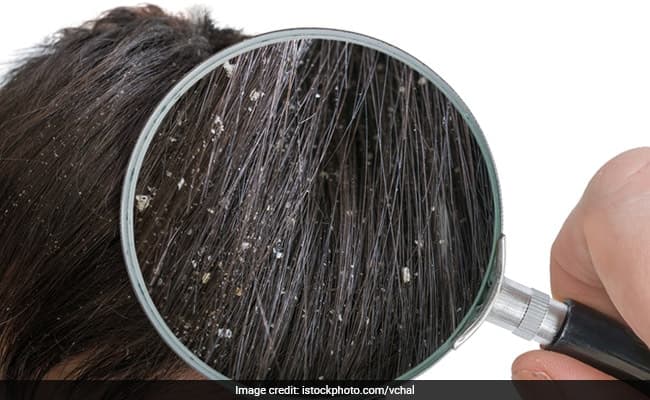 Dandruff Control: Know The Causes And Most Effective Time-Tested Remedies