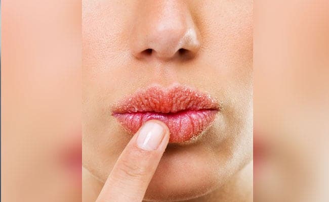 Dry weather can cause the lips to get dry and chapped