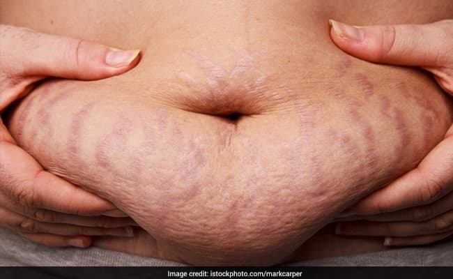 Reduce stretch marks with these natural techniques