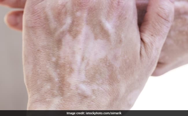 White spots on skin do not cause any major symptoms