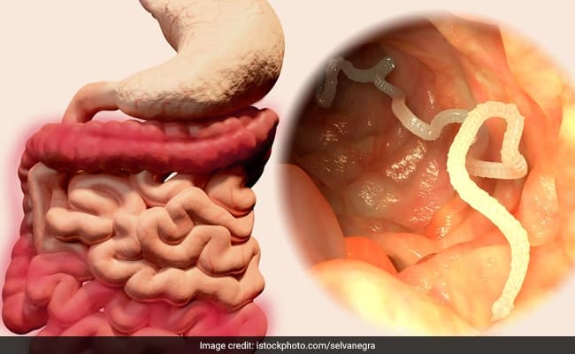 These worms, if not diagnosed early, can cause immense blood loss and complications