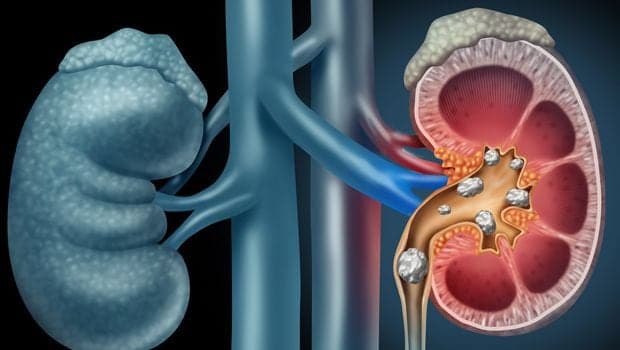 Foods To Eat And Avoid In Case Of Kidney Stones