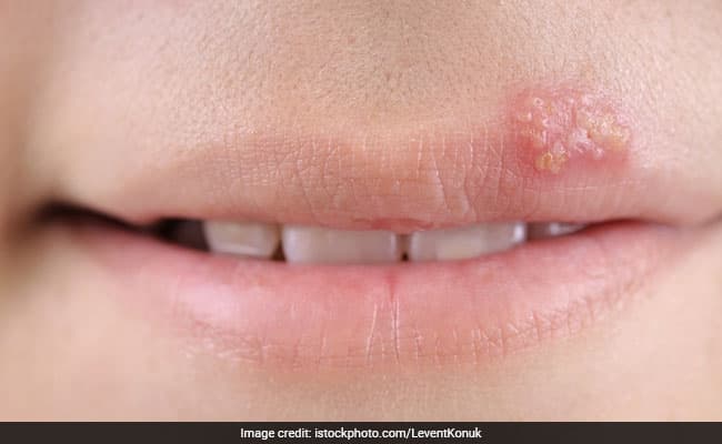 Herpes appear as cold sores on the body