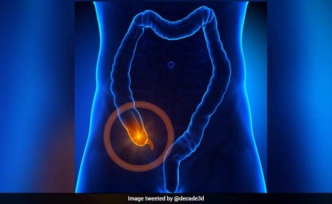 Appendix pain or appendicitis takes place as a result of appendix inflammation