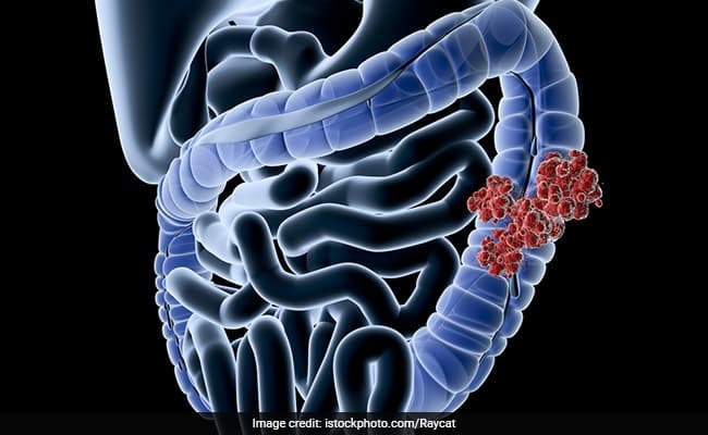 Colorectal cancer is also known as bowel cancer, colon cancer, or rectal cancer