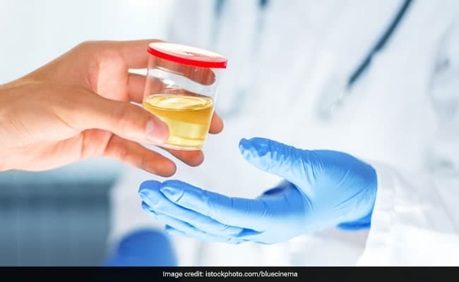 High levels of uric acid in urine can also signal kidney stones