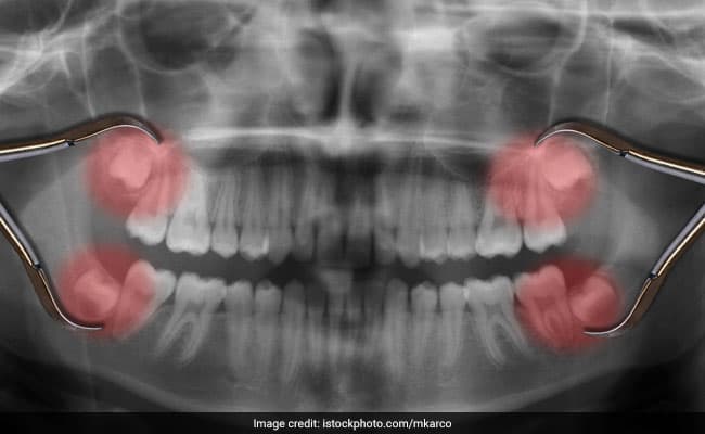 Wisdom tooth pain can be an unpleasant experience for some people