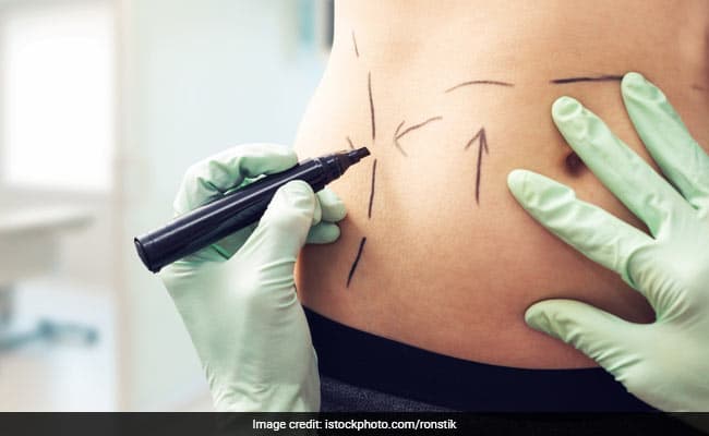 Liposuction is a surgery which can help in making cellulite less visible
