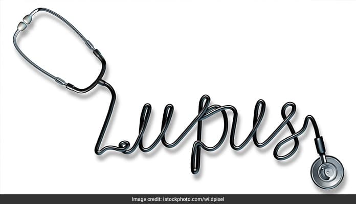 Women are more prone to lupus than men